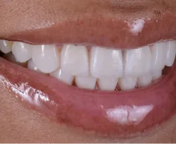 After dental treatment - improved smile