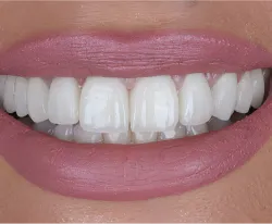 After dental treatment - restored teeth