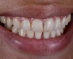 Before dental treatment - patient smile