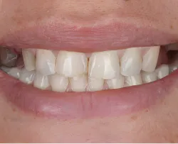 Before dental treatment - patient teeth