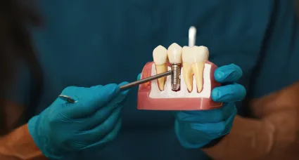Dental Implants